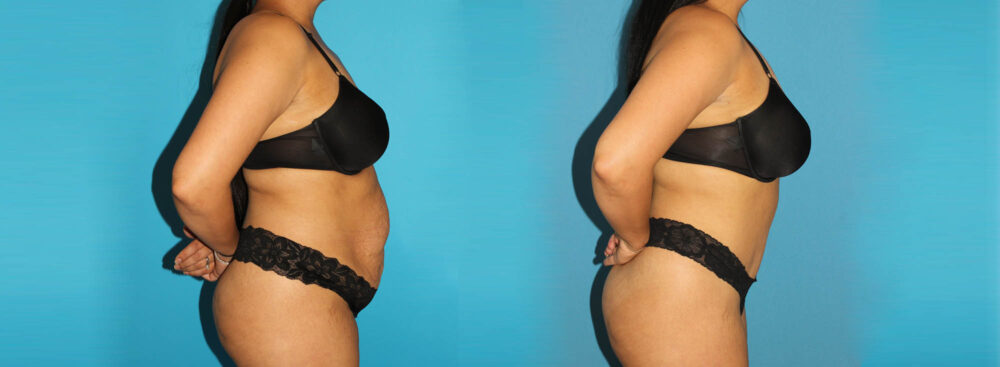 Tummy Tuck case #7276