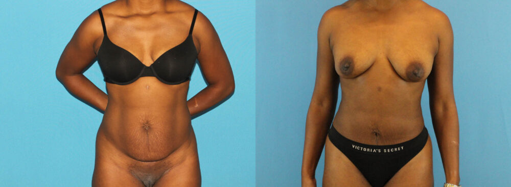 Tummy Tuck case #7341