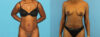 Tummy Tuck case #7341 slider thumbnail