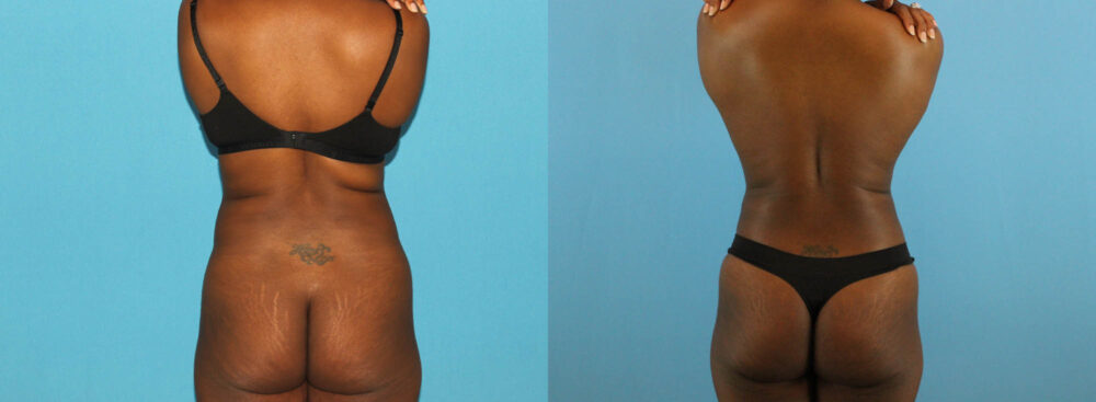 Tummy Tuck case #7341