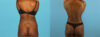 Tummy Tuck case #7341 slider thumbnail