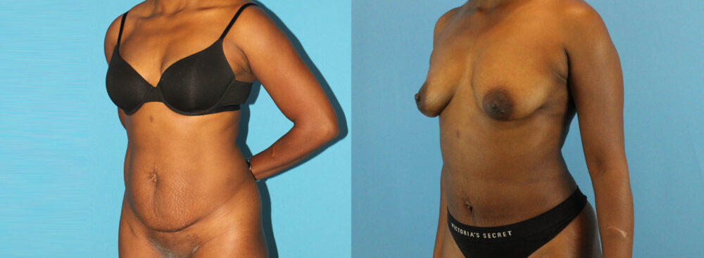 Tummy Tuck case #7341
