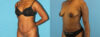 Tummy Tuck case #7341 slider thumbnail