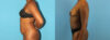 Tummy Tuck case #7341 slider thumbnail