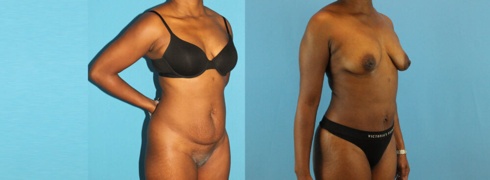 Tummy Tuck case #7341