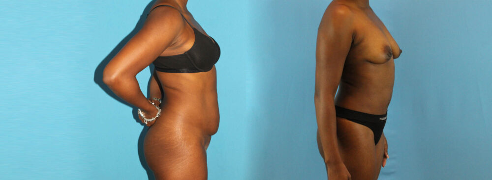 Tummy Tuck case #7341