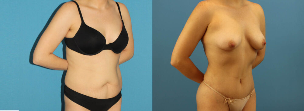 Tummy Tuck case #7343