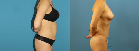 Tummy Tuck case #7343