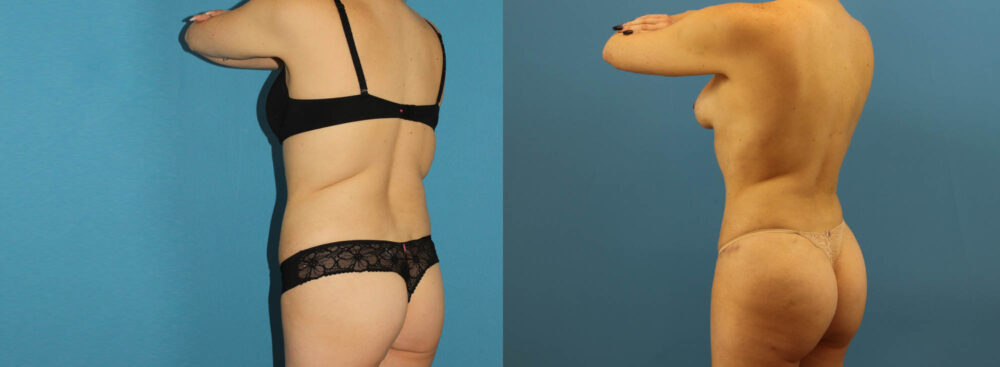 Tummy Tuck case #7343