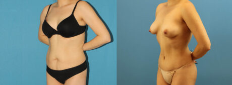 Tummy Tuck case #7343