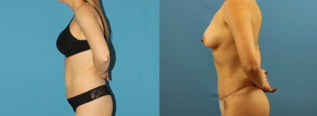 Tummy Tuck case #7343