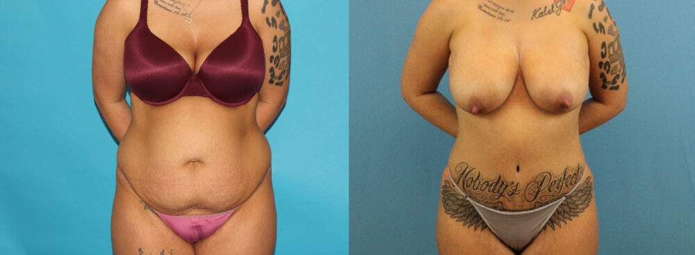 Tummy Tuck case #7344