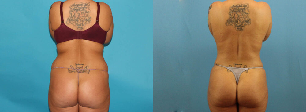 Tummy Tuck case #7344