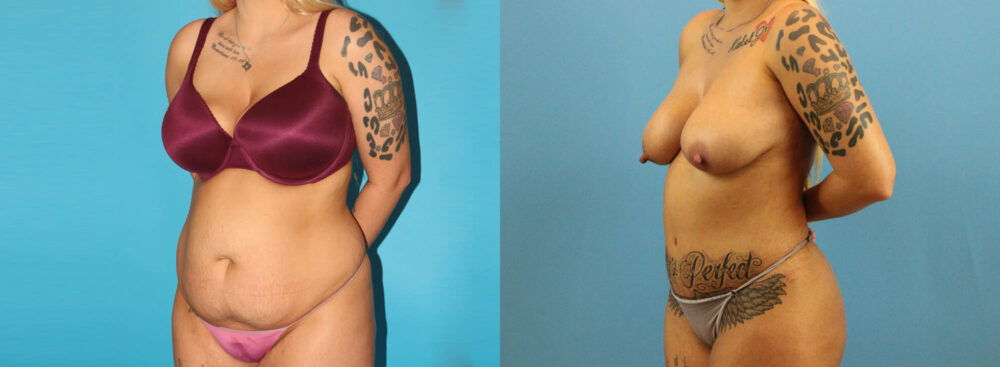 Tummy Tuck case #7344