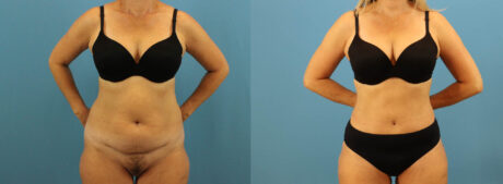 Tummy Tuck case #7345