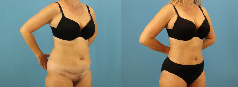 Tummy Tuck case #7345