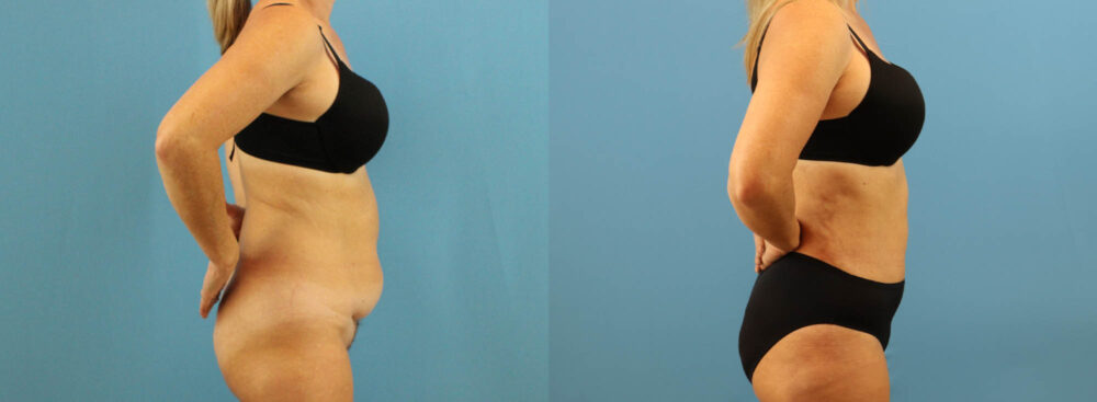 Tummy Tuck case #7345