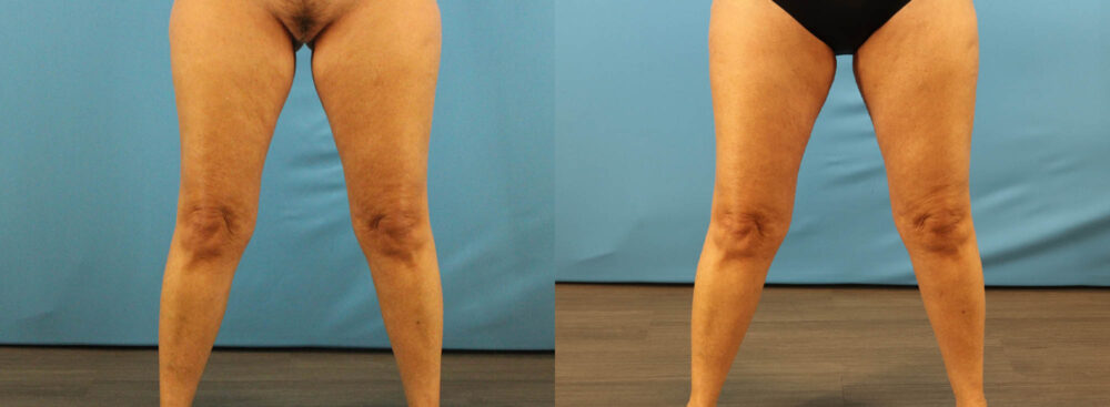 Tummy Tuck case #7345