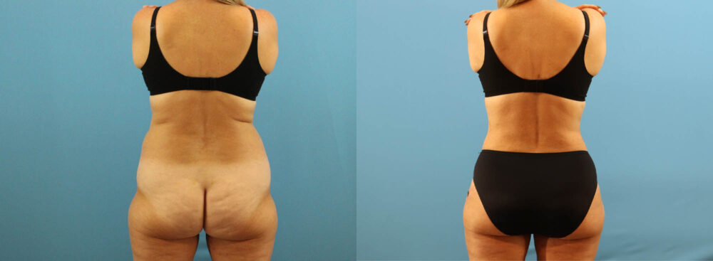 Tummy Tuck case #7345
