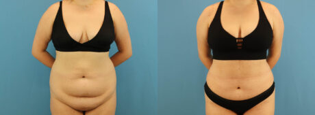 Tummy Tuck case #7346