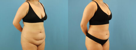 Tummy Tuck case #7346