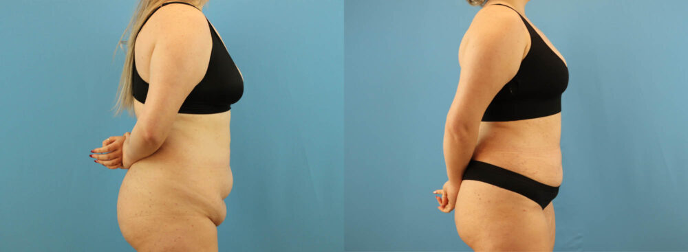 Tummy Tuck case #7346