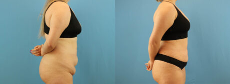 Tummy Tuck case #7346