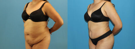 Tummy Tuck case #7347