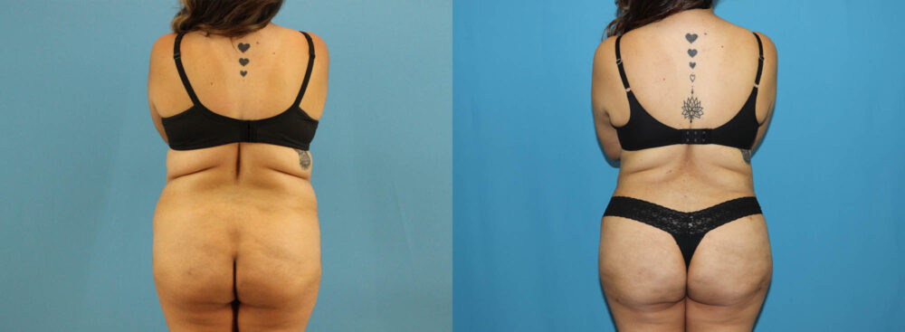 Tummy Tuck case #7347