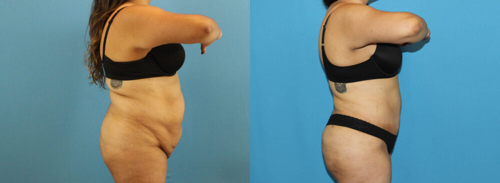 Tummy Tuck case #7347