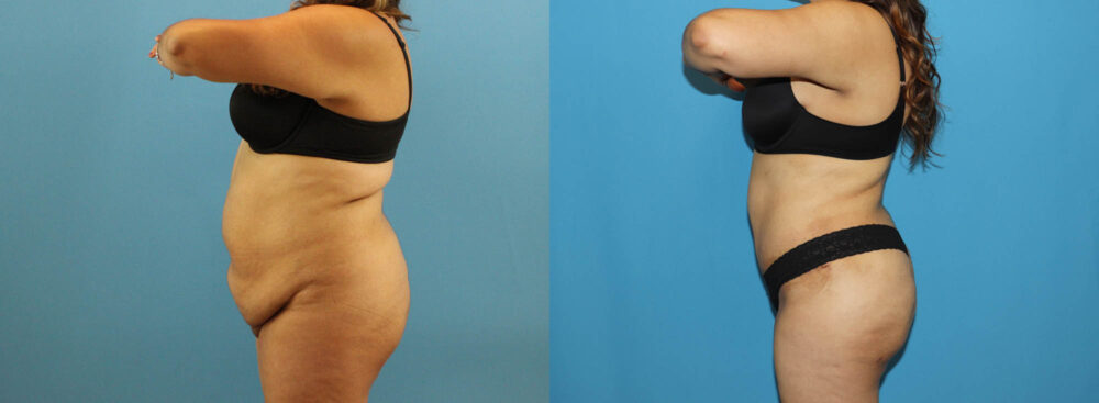 Tummy Tuck case #7347