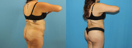 Tummy Tuck case #7347