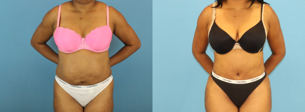 Tummy Tuck case #7348