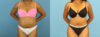 Tummy Tuck case #7348 slider thumbnail