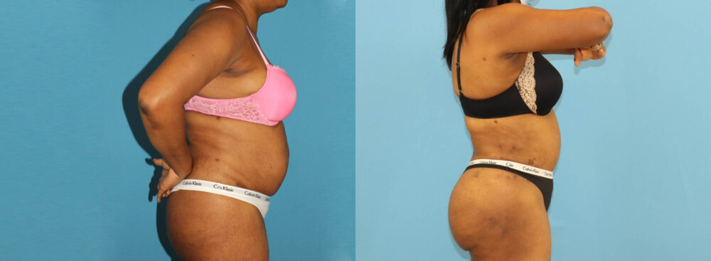 Tummy Tuck case #7348