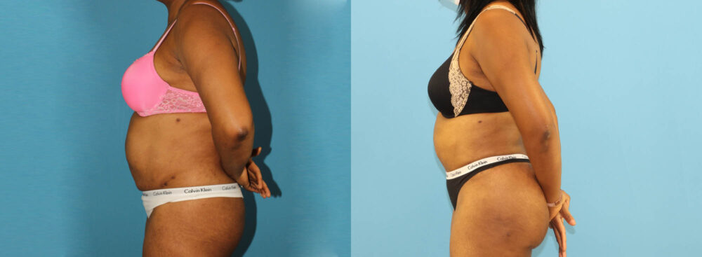 Tummy Tuck case #7348