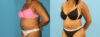 Tummy Tuck case #7348 slider thumbnail