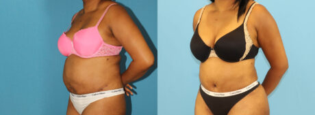Tummy Tuck case #7348
