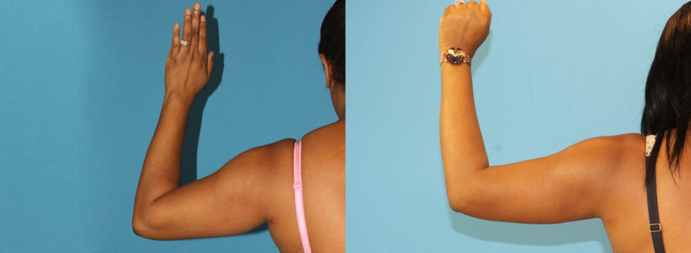 Tummy Tuck case #7348