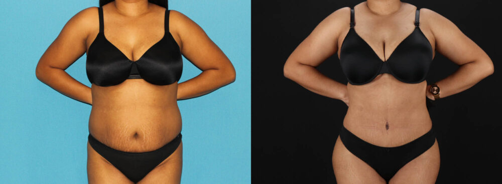 Tummy Tuck case #7349