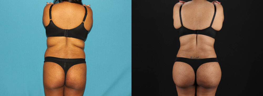 Tummy Tuck case #7349