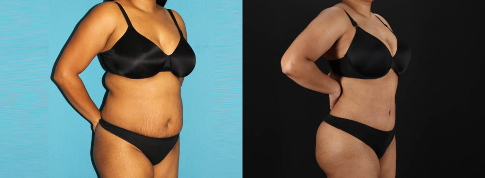 Tummy Tuck case #7349