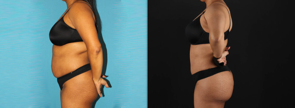 Tummy Tuck case #7349