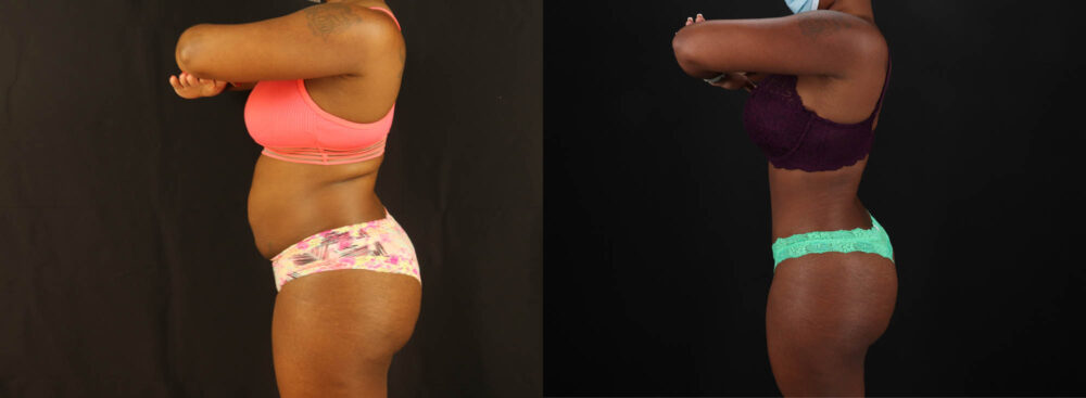 Tummy Tuck case #7282