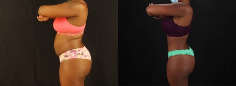 Tummy Tuck case #7282