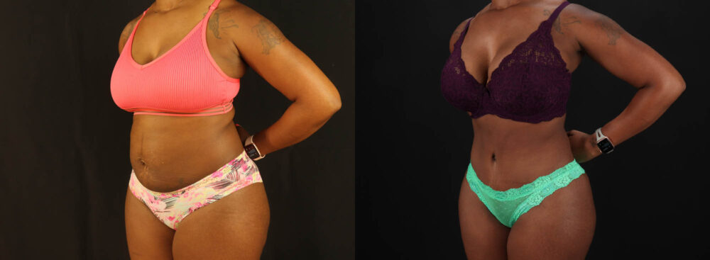 Tummy Tuck case #7282