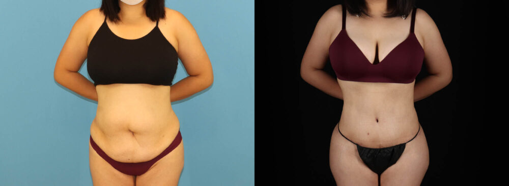 Tummy Tuck case #7352