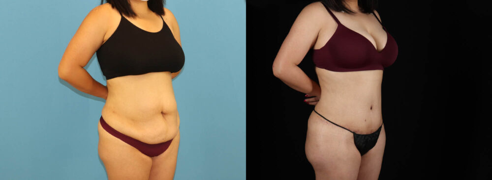 Tummy Tuck case #7352