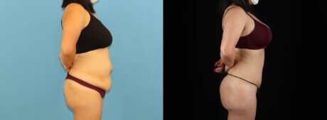 Tummy Tuck case #7352