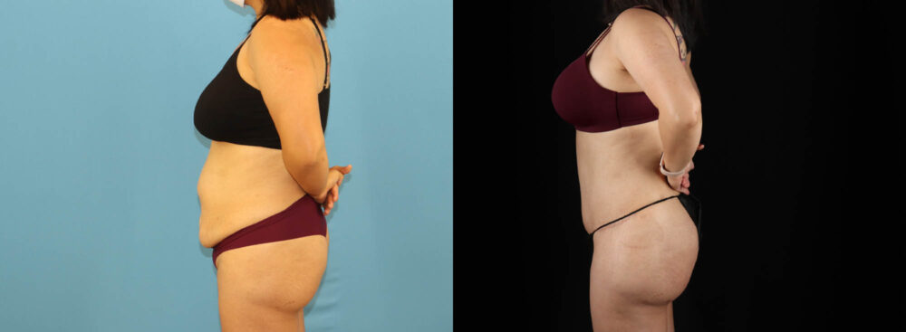 Tummy Tuck case #7352